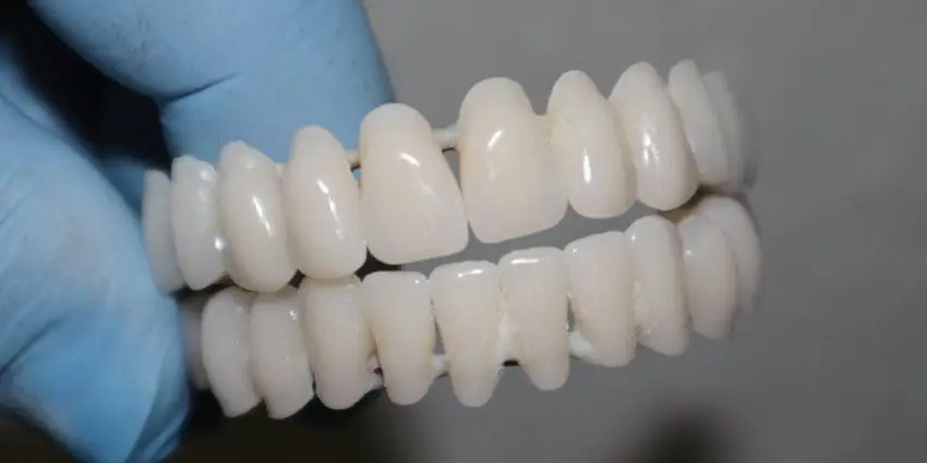 Composite vs Porcelain Veneers: Pros, Cons, and Costs