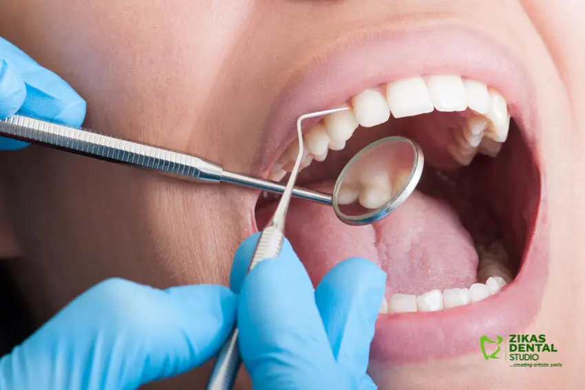 Zikas Dental - Scaling and Polishing