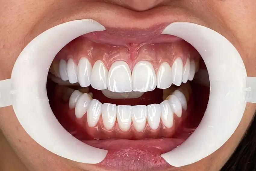 Composite Veneers dentist in Enugu