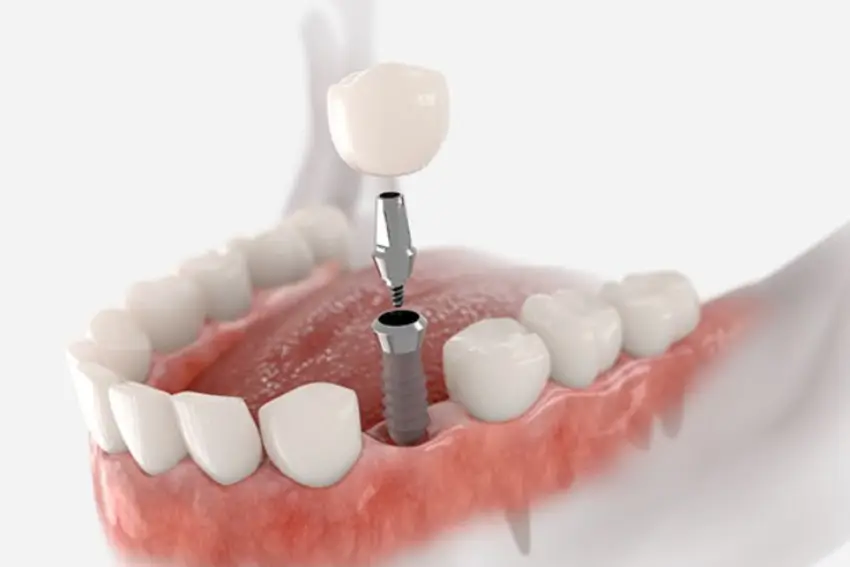 Dental Implant - Zikas Dental Studio