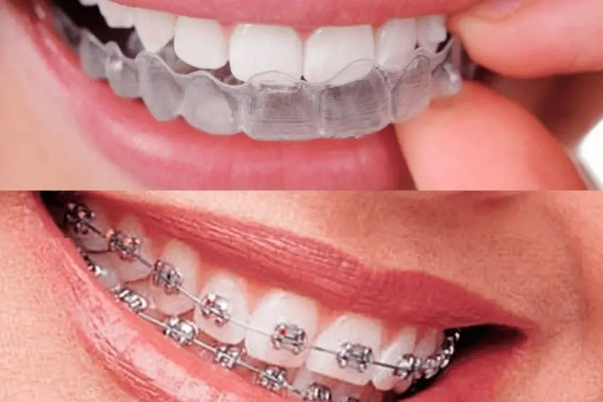 Braces & Invisalign Zikas Dental Studio